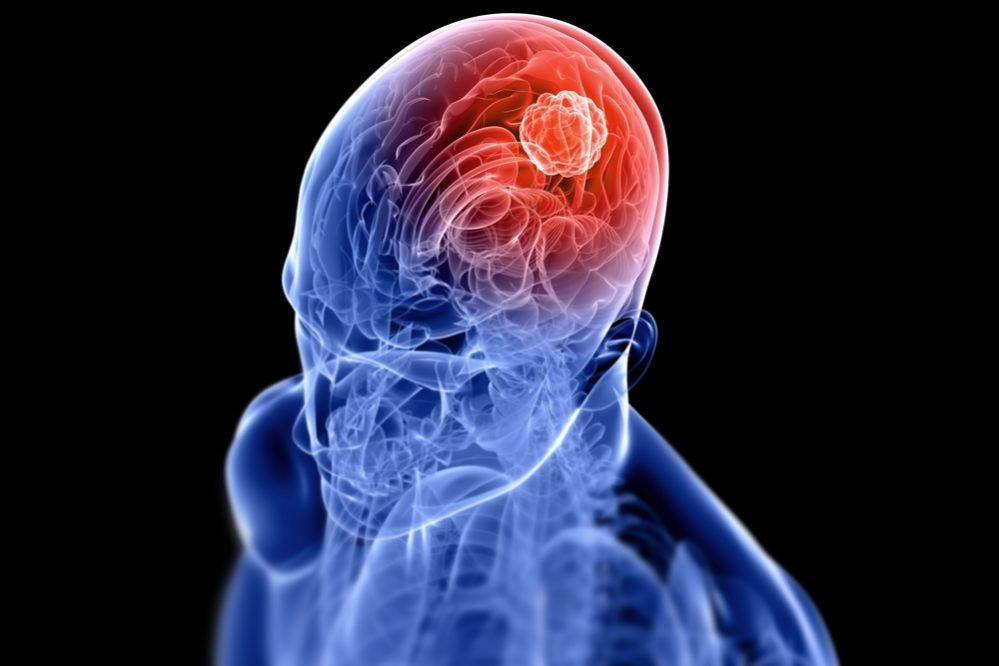 symptoms and warning signs of a brain tumor
