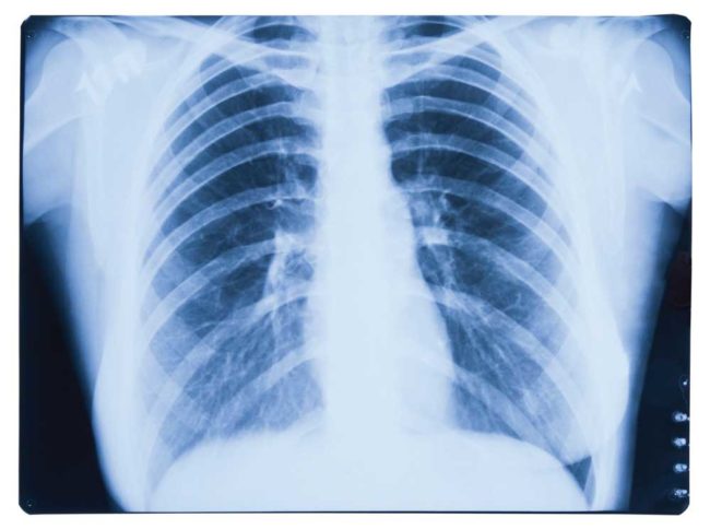 Lung Cancer Screening Lung Cancer Screening