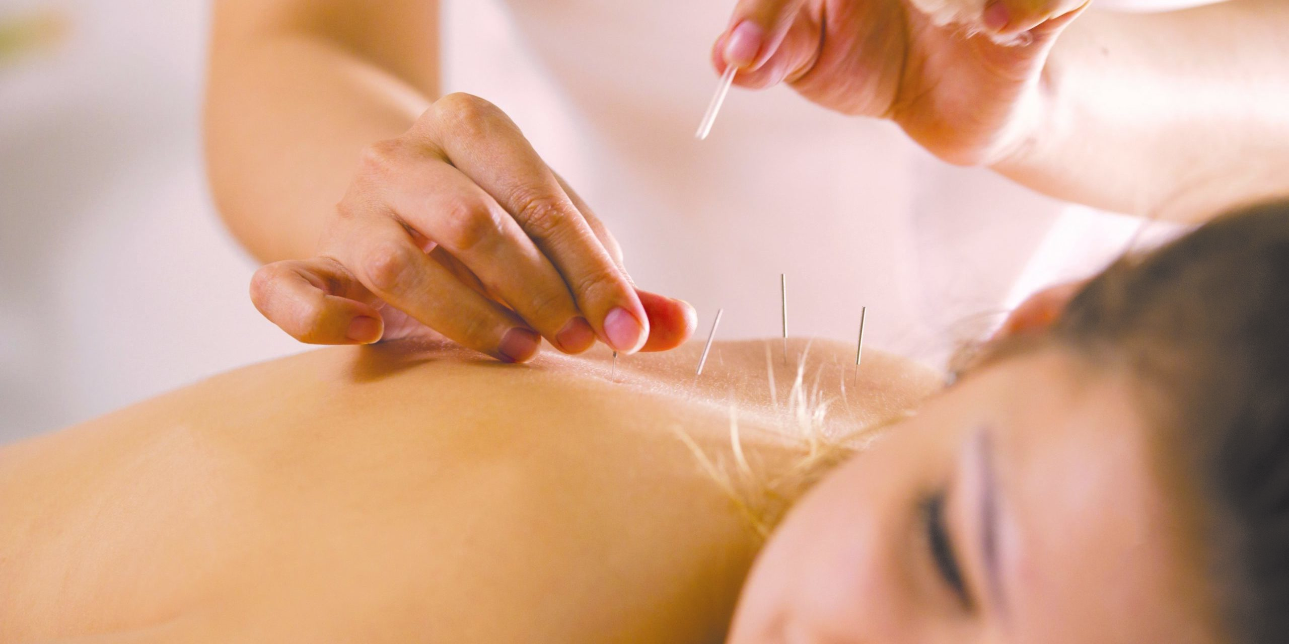 Acupuncture treatment