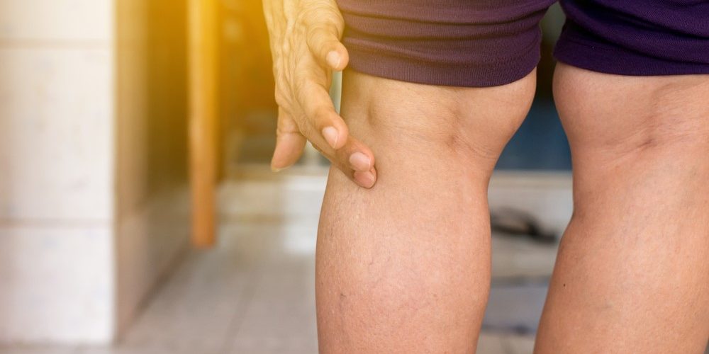 Varicose Veins Varicose veins on back of legs