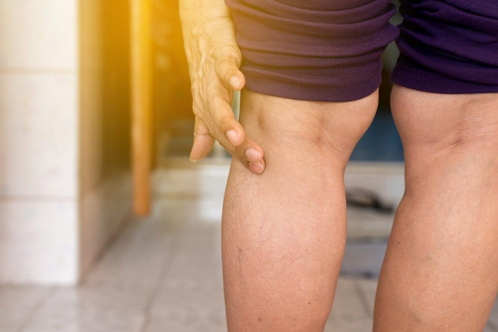 Varicose veins on back of legs