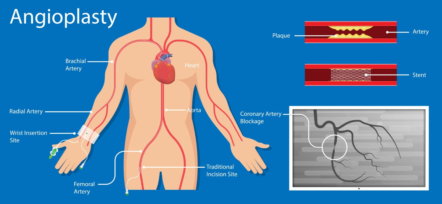 Cardiac Cath Lab - Mather Hospital