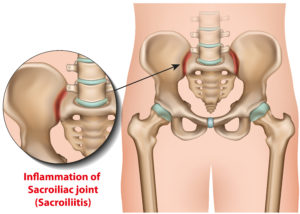 13 Causes of Low-Back and Hip Pain on One Side