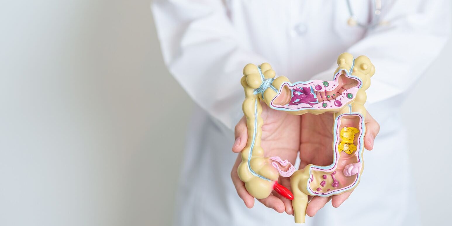 Can you prevent colon cancer?